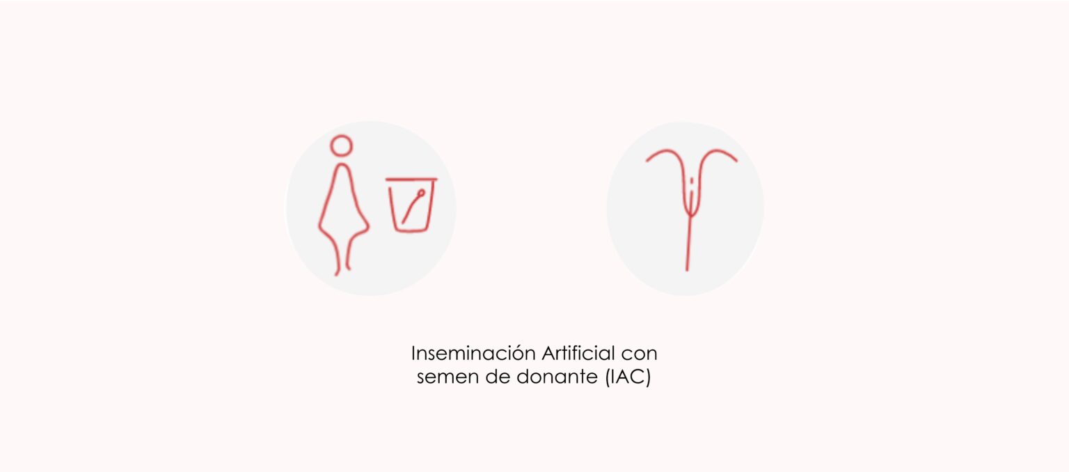 En Qu Consiste La Inseminaci N Artificial Con Donante De Semen