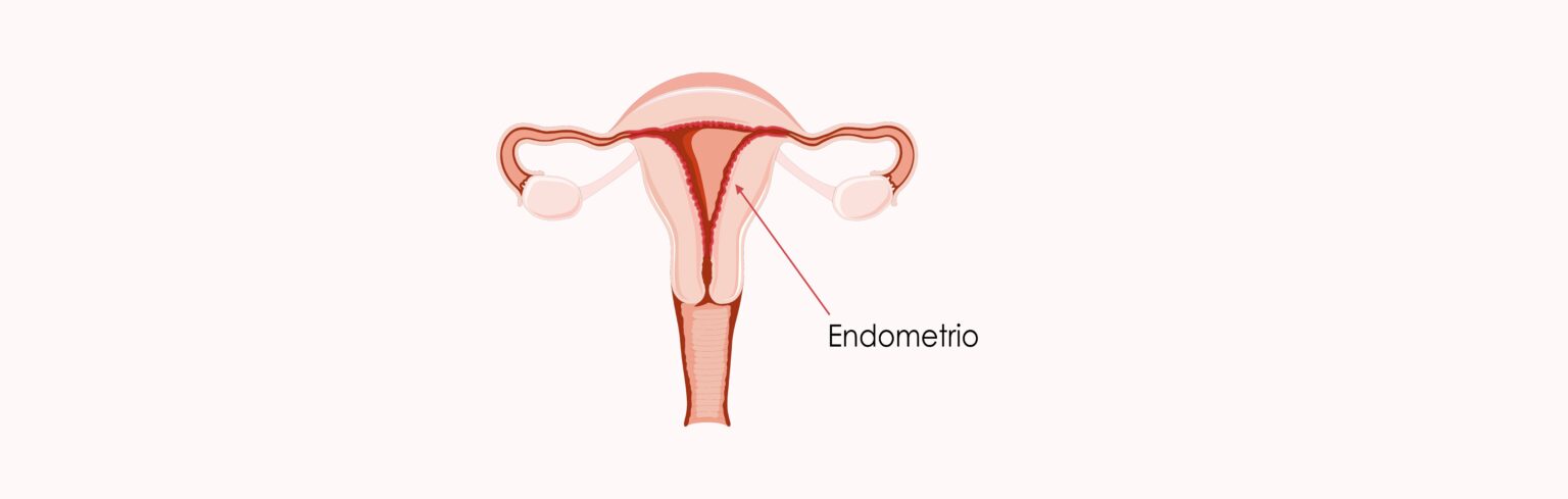 ¿por Qué Es Necesario Hacer Una Biopsia De Endometrio 