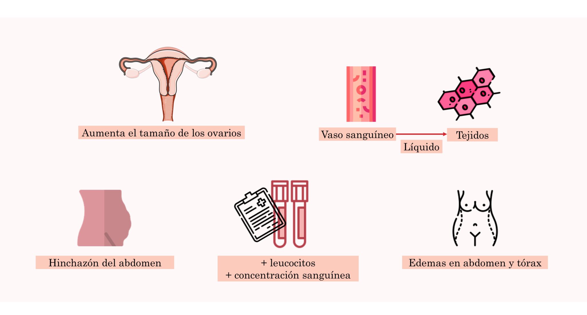 Síndrome De Hiperestimulación Ovárica ¿qué Es Y Cómo Se Cura - Mobile