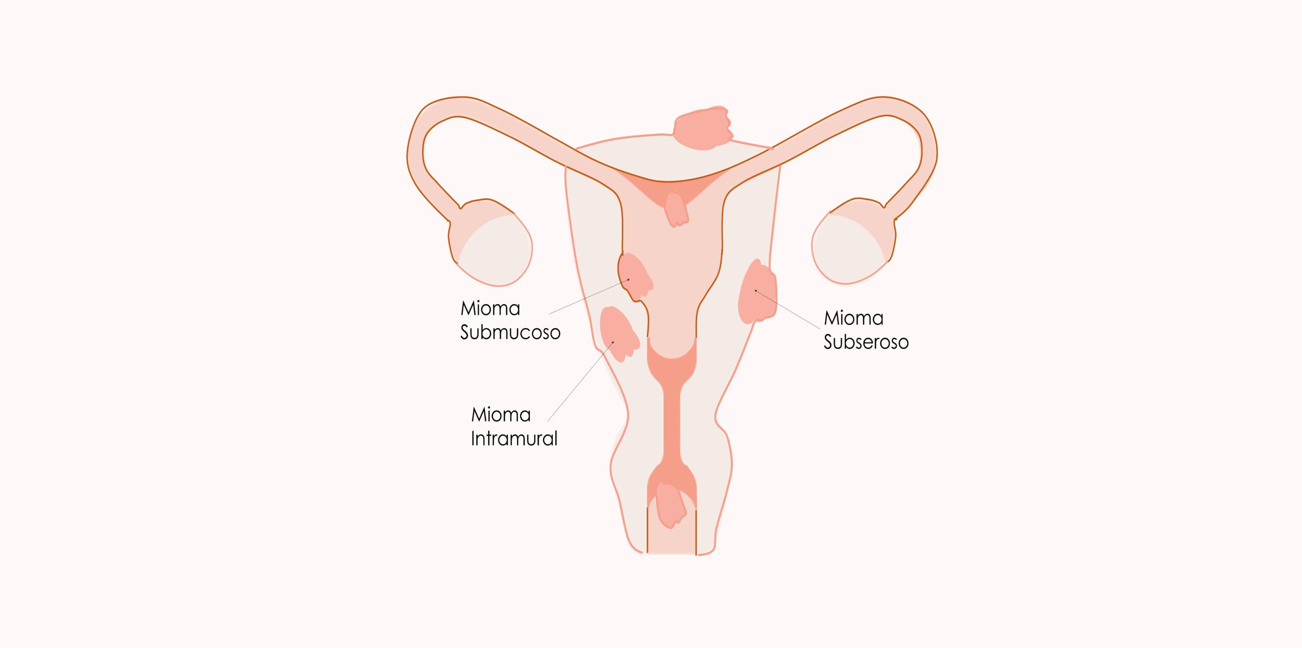 Tipos de miomas uterinos