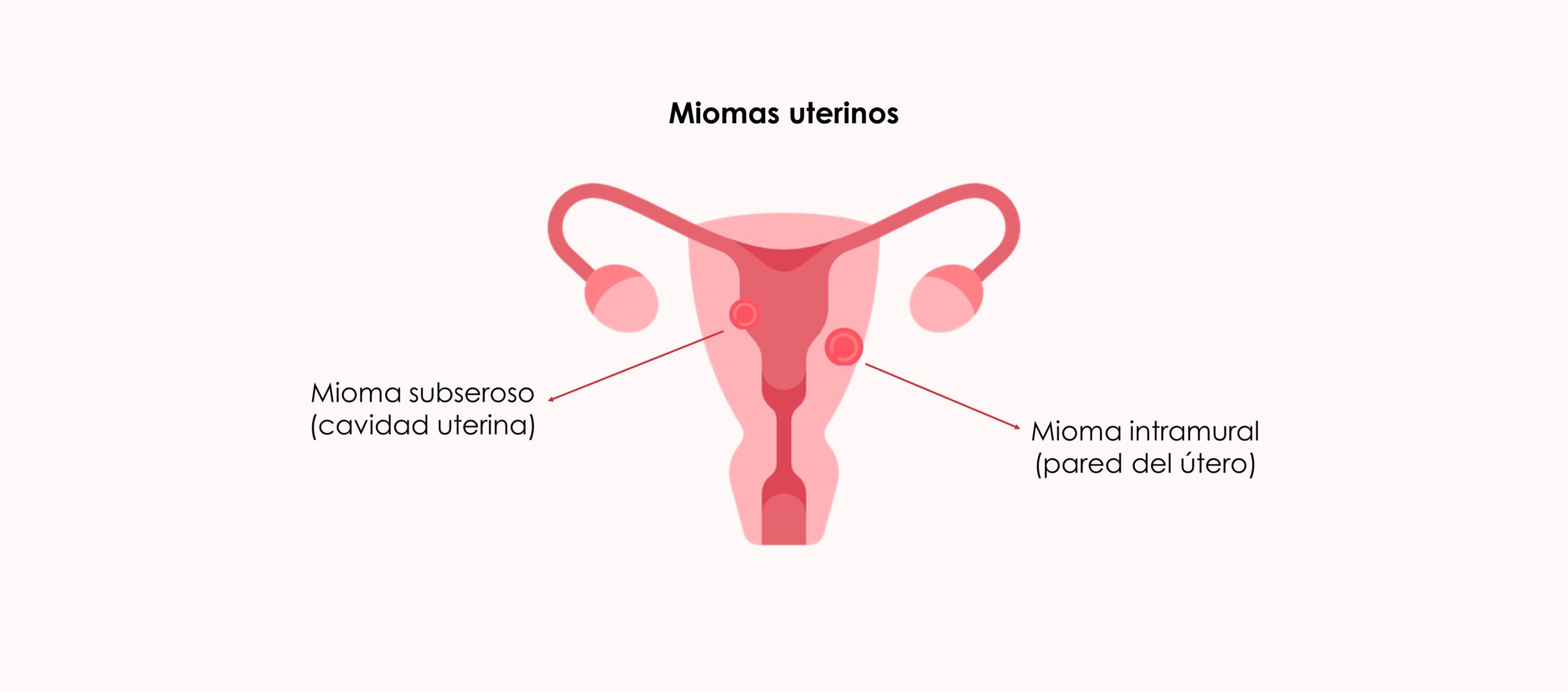 Radiofrecuencia y miomas uterinos