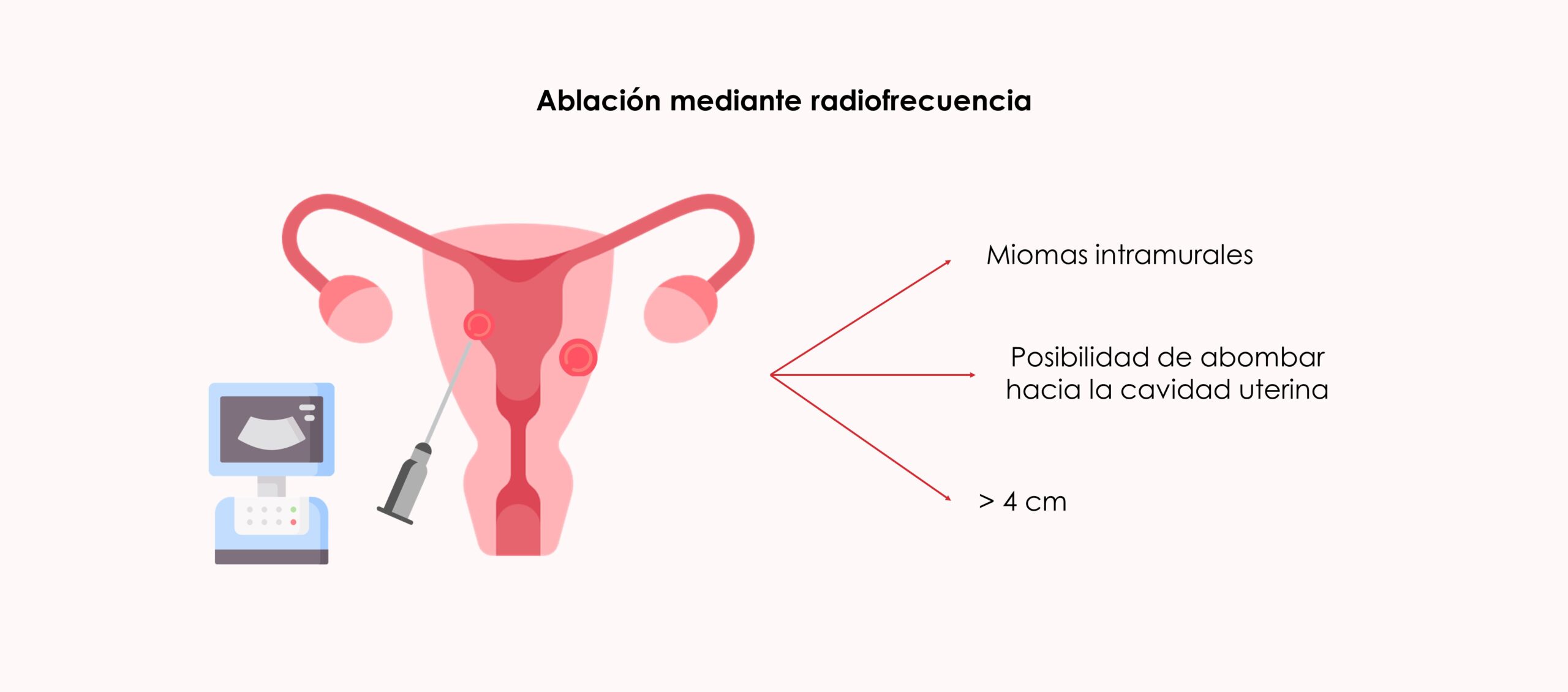 Radiofrecuencia y miomas uterinos